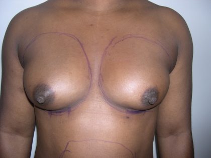 Breast Augmentation Before & After Patient #3711
