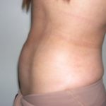 Liposuction Before & After Patient #3826