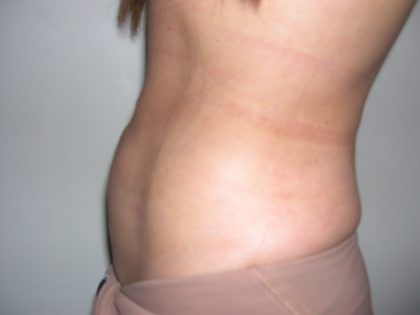 Liposuction Before & After Patient #3826