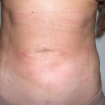 Liposuction Before & After Patient #3826