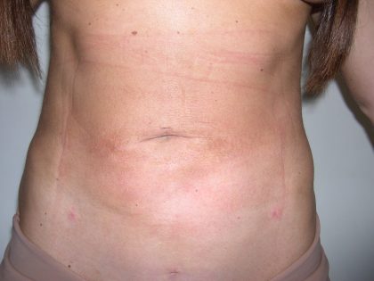 Liposuction Before & After Patient #3826