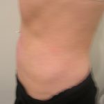 Liposuction Before & After Patient #3826