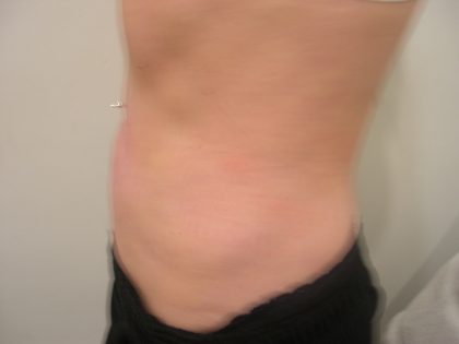 Liposuction Before & After Patient #3826