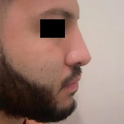 Rhinoplasty Male Before & After Patient #3904