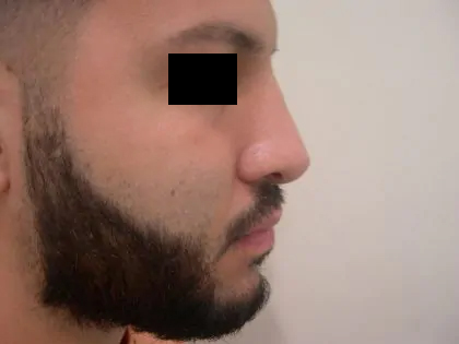 Rhinoplasty Male Before & After Patient #3904