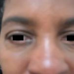 Eyelid Surgery Before & After Patient #3669