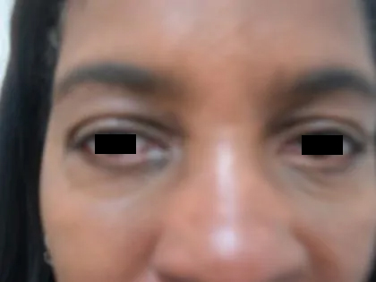 Eyelid Surgery Before & After Patient #3669