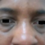 Eyelid Surgery Before & After Patient #3669