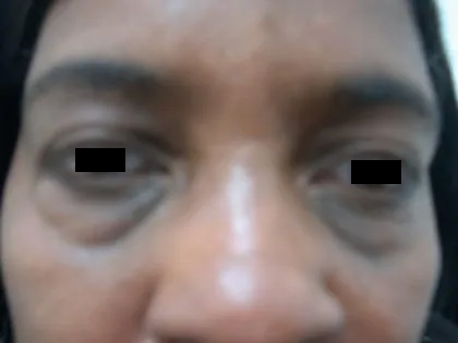Eyelid Surgery Before & After Patient #3669