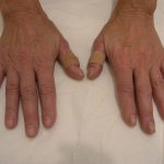 Fat Transfer to Hands Before & After Patient #3798