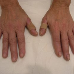 Fat Transfer to Hands Before & After Patient #3798