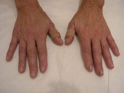 Fat Transfer to Hands Before & After Patient #3798
