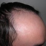 Hair Restoration Before & After Patient #2751