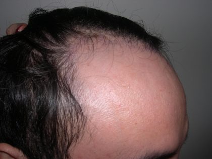 Hair Restoration Before & After Patient #2751