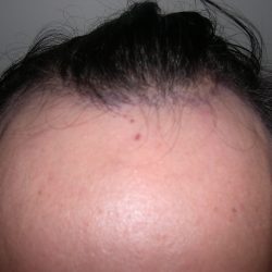 Hair Restoration Before & After Patient #3877