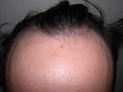 Hair Restoration Before & After Patient #2751
