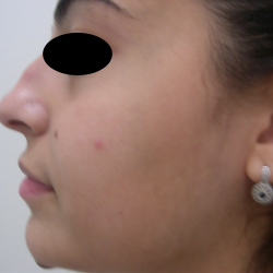 Rhinoplasty Before & After Patient #3856