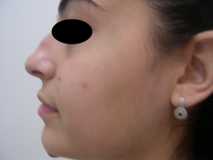 Rhinoplasty Before & After Patient #3856