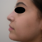 Rhinoplasty Before & After Patient #3856