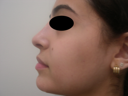 Rhinoplasty Before & After Patient #3856