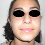 Rhinoplasty Before & After Patient #3856