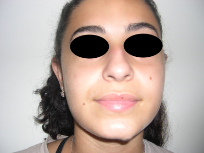 Rhinoplasty Before & After Patient #3856