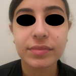 Rhinoplasty Before & After Patient #3856