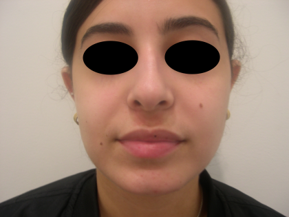 Rhinoplasty Before & After Patient #3856