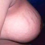 Breast Reduction Before & After Patient #2349