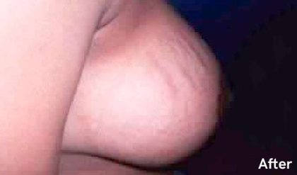 Breast Reduction Before & After Patient #2349