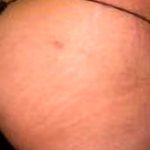 Buttock Augmentation Before & After Patient #2441
