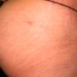 Buttock Augmentation Before & After Patient #2441