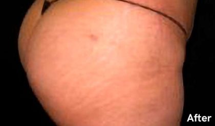 Buttock Augmentation Before & After Patient #2441