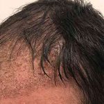 Hair Restoration Before & After Patient #2784