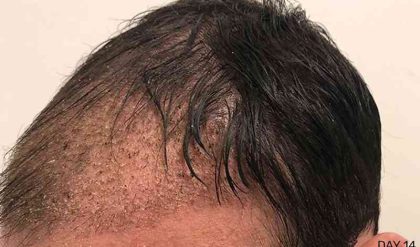Hair Restoration Before & After Patient #2784
