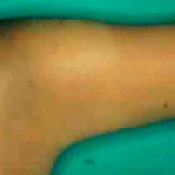 Liposuction Before & After Patient #2867