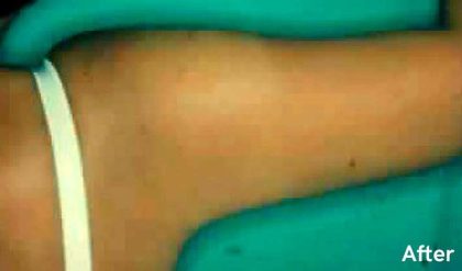 Liposuction Before & After Patient #2867