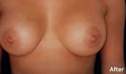 Breast Augmentation Before & After Patient #2242