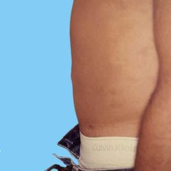 Liposuction Male Before & After Patient #2909