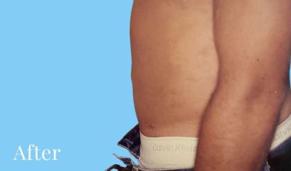Liposuction Male Before & After Patient #2909