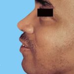 Rhinoplasty Male Before & After Patient #3030