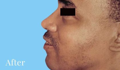 Rhinoplasty Male Before & After Patient #3030