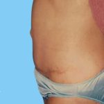 Tummy Tuck Before & After Patient #3069