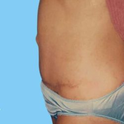 Tummy Tuck Before & After Patient #3069