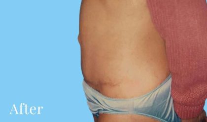 Tummy Tuck Before & After Patient #3069