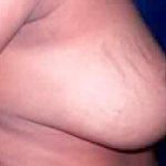 Breast Reduction Before & After Patient #2349