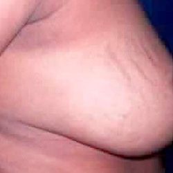 Breast Reduction Before & After Patient #2349