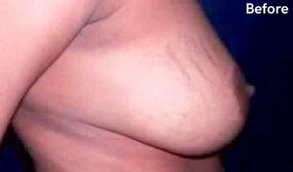 Breast Reduction Before & After Patient #2349