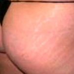 Buttock Augmentation Before & After Patient #2441