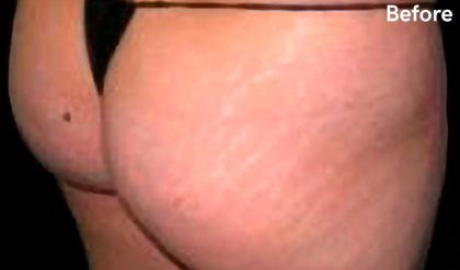 Buttock Augmentation Before & After Patient #2441